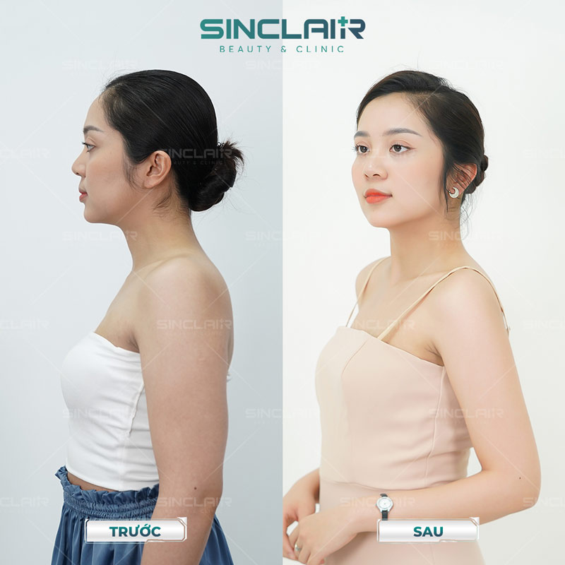 Hình ảnh khách hàng trước và sau khi sử dụng dịch vụ Vai cổ thiên nga tại Sinclair