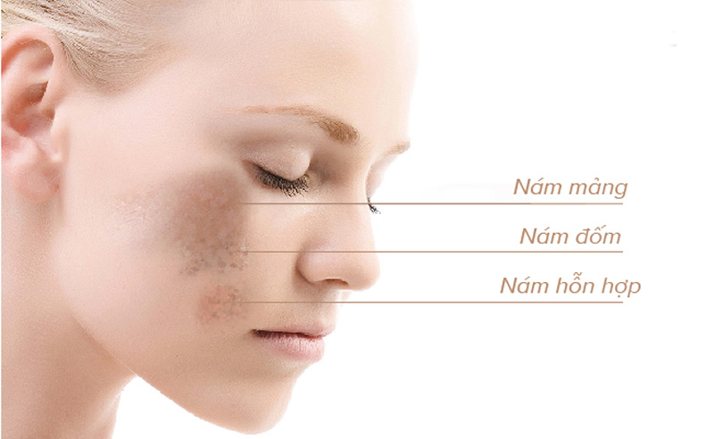 Những ảnh hưởng xấu từ môi trường xung quanh gây nám trên da mặt xuất hiện