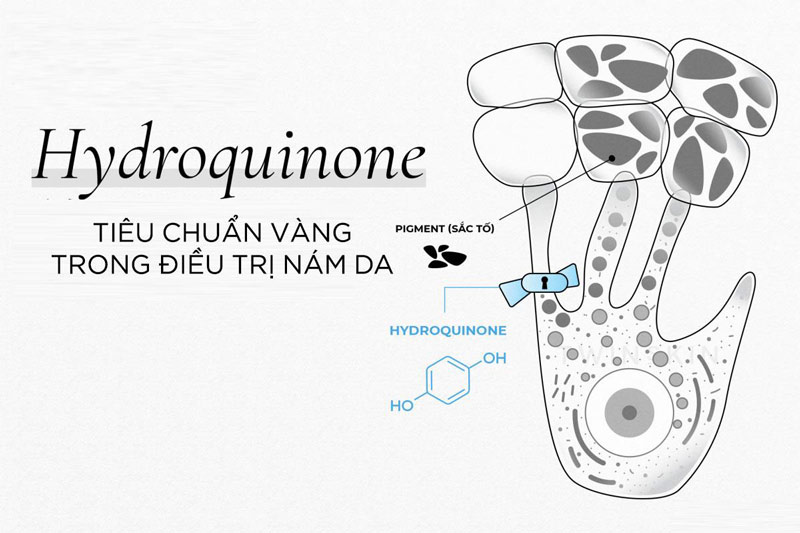 Quá trình điều trị nám với hydroquinone được tuân thủ theo chuẩn y khoa 