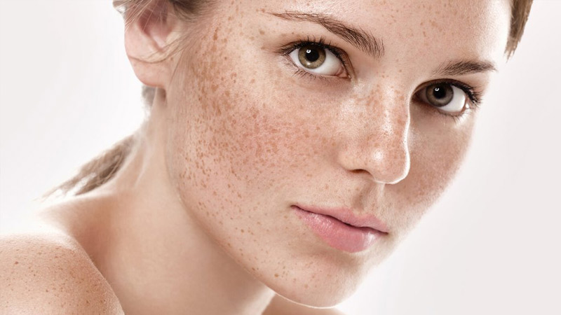 Dầu dừa dưỡng da mặt có tốt không? Dầu dừa giúp ngăn ngừa tình trạng thâm nám, tàn nhang cho da
